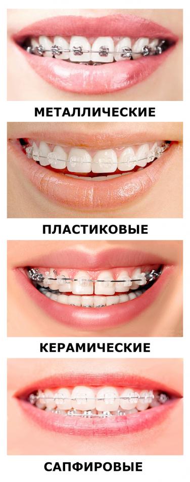 Виды брекетов
