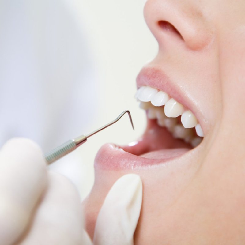 Почему выпадает зубная пломба после лечения?