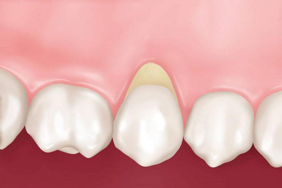 Клиновидный дефект зубов: причины и симптомы.