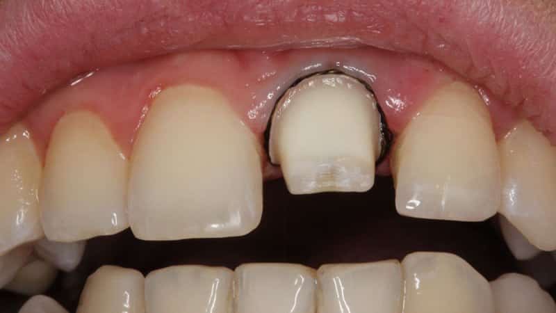 Болит зуб под коронкой: почему, что делать?