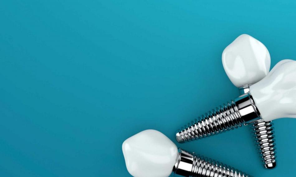 Правда и мифы об имплантации зубов.