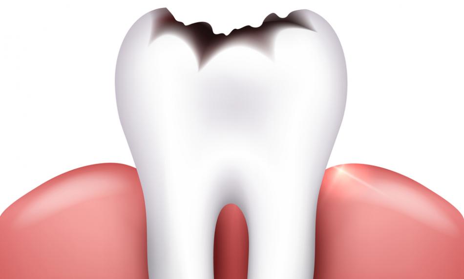 Стоимость лечения зуба с пломбировкой каналов.