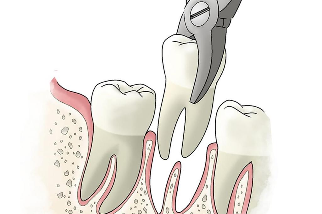 Как удаляют зуб, если корень разрушен?