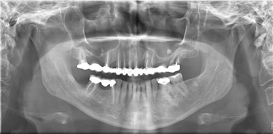 Панорамный снимок зубов Томск Приветливая Импланты AB Dental Томск Горшковский