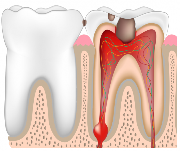 Лечение хронического пульпита зуба у ребенка.