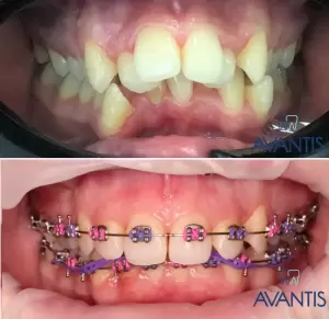 Фотография Авантис 3